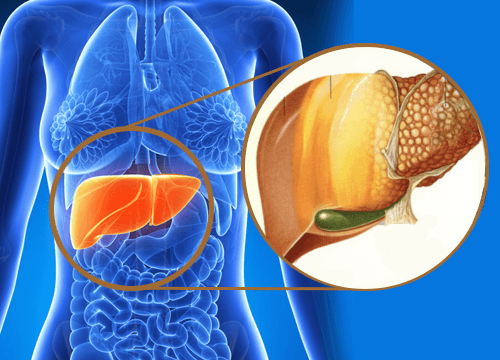 Fegato grasso: la mutazione di una proteina predice la fibrosi epatica nei bambini e adulti