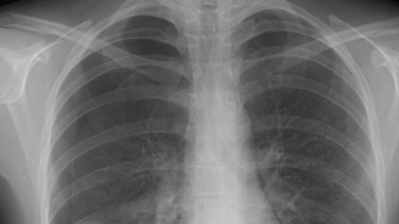 Fibrosi polmonare idiopatica, la risposta del pirfenidone sotto forma di aerosol