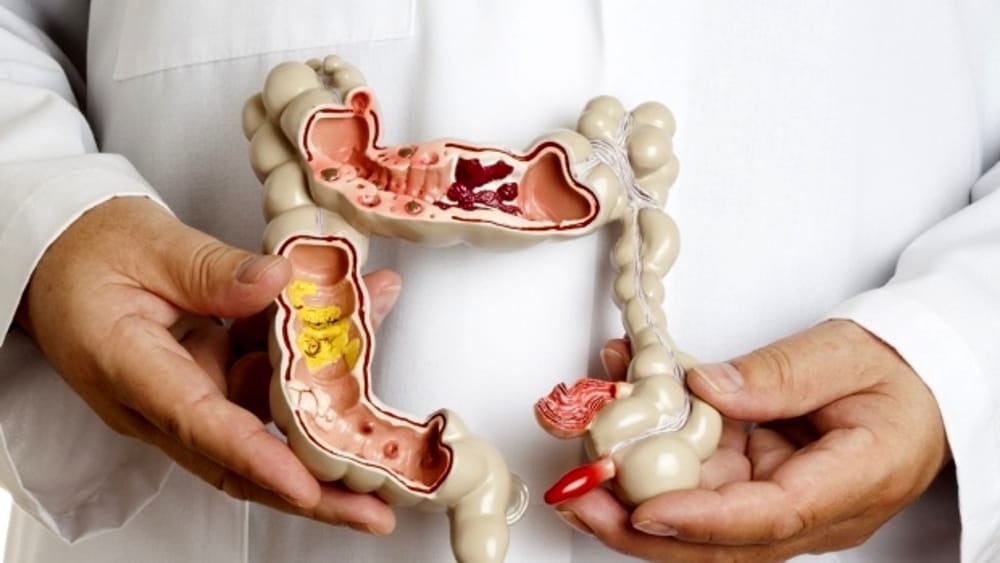 Malattie infiammatorie croniche intestinali, Sileri: “Tavolo tecnico per la programmazione e la ricerca”