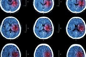 Rapid Medical avvierà il primo trial in assoluto per estendere il trattamento dell’ictus ad aree cerebrali distali