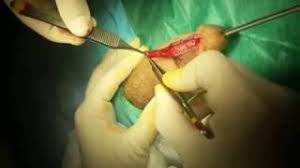 A Rovereto il primo intervento di riparazione dell’uretra con la mucosa della bocca
