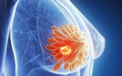 Tumori: arriva il test genomico per cure ad hoc del cancro al seno