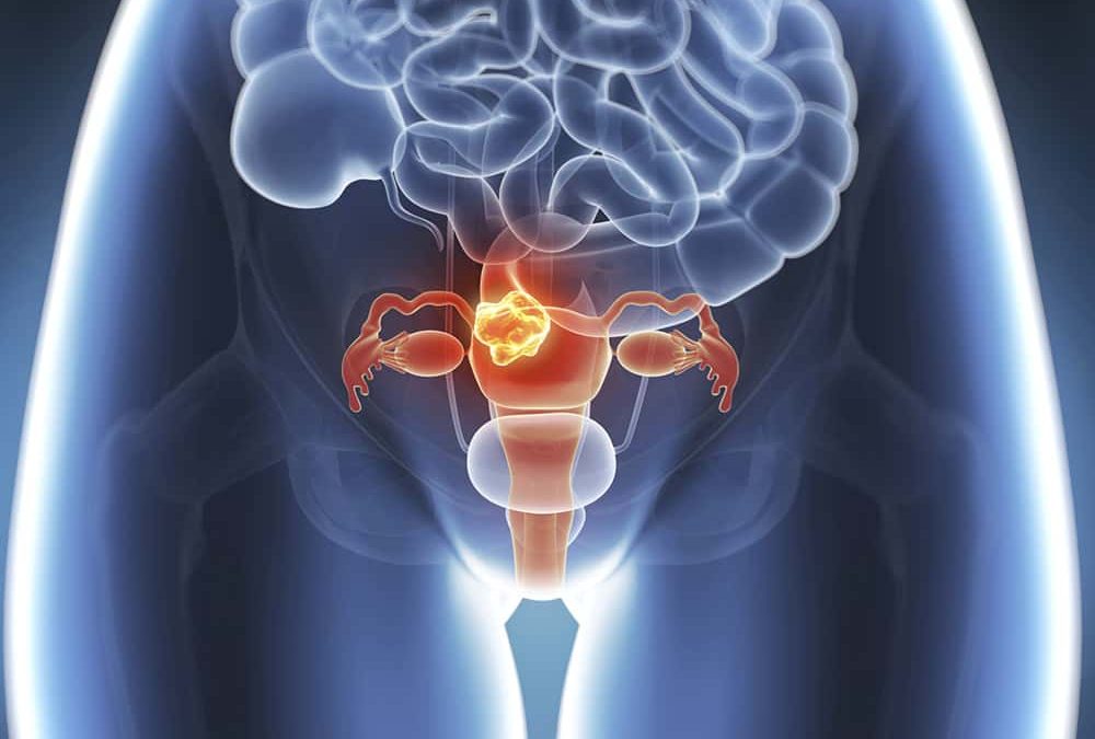 Fibromi uterini, Theramex e ObsEva lanciano Linzagolix