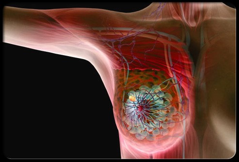 Tumore mammario, focus sui test genomici al congresso dell’American Society of Clinical Oncology