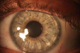 Stop trapianti di cornea, basterà un’iniezione di cellule endoteliali