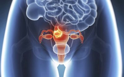 Fibromi uterini, via libera alla commercializzazione di linzagolix