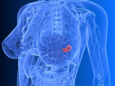 ImPrint identifica le pazienti affette da tumore al seno in fase precoce con valutazione ‘High Risk’
