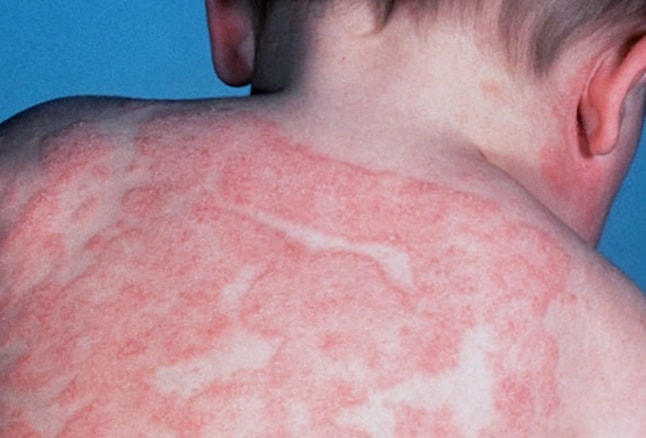 Dermatite atopica, Leo Pharma riceve il parere positivo del CHMP su Adtralza
