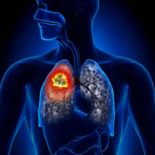 Tumore del polmone a piccole cellule, Aifa approva la rimborsabilità di durvalumab