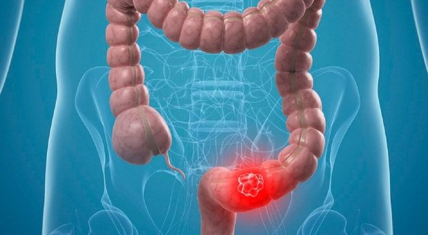 Tumore colorettale metastico, con fruquintinib nuova opzione terapeutica