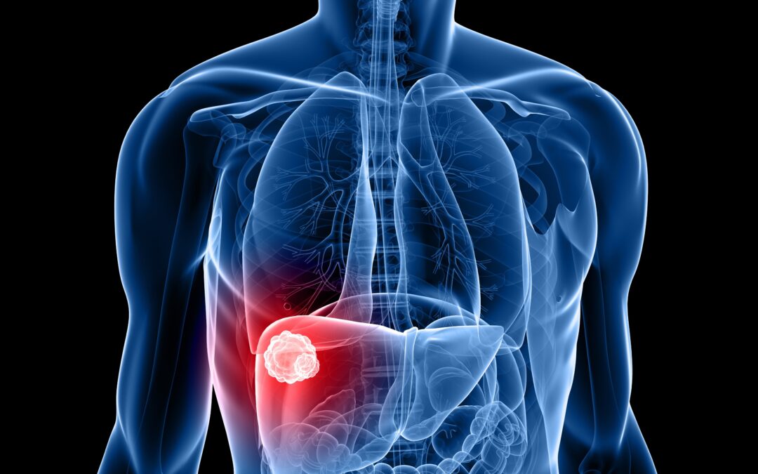 Tumore del fegato, pubblicate le nuove linee guida per un approccio terapeutico innovativo