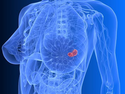 Obesità fattore di rischio per il tumore al seno