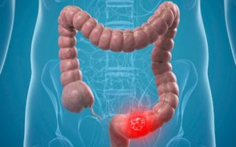 Tumore colorettale metastatico, avviata richiesta di autorizzazione all’immissione in commercio per fruquintinib