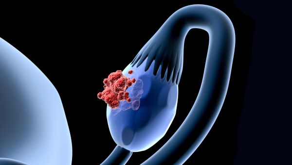 Exscientia avvia uno studio prospettico osservazionale sul tumore ovarico