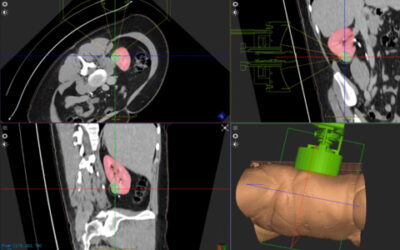 Il primo trattamento al mondo su tumore renale eseguito con il sistema di istotripsia Edison di HistoSonics